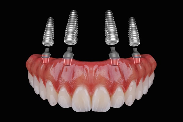 Common Issues With All On   Implants And How To Avoid Them