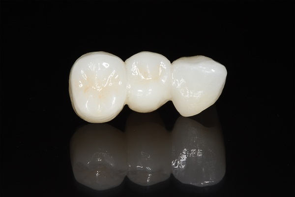 How To Make Your Dental Bridge Last