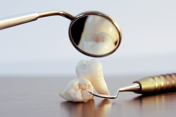 How To Choose Between Tooth Extraction And Root Canal
